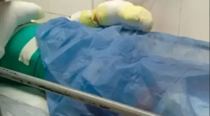 Le explotó el celular y sufrió quemaduras en el 60% del cuerpo