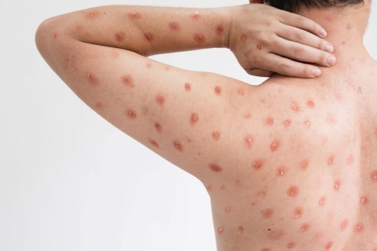 Detectaron en el país el primer caso de viruela del mono de mayor severidad